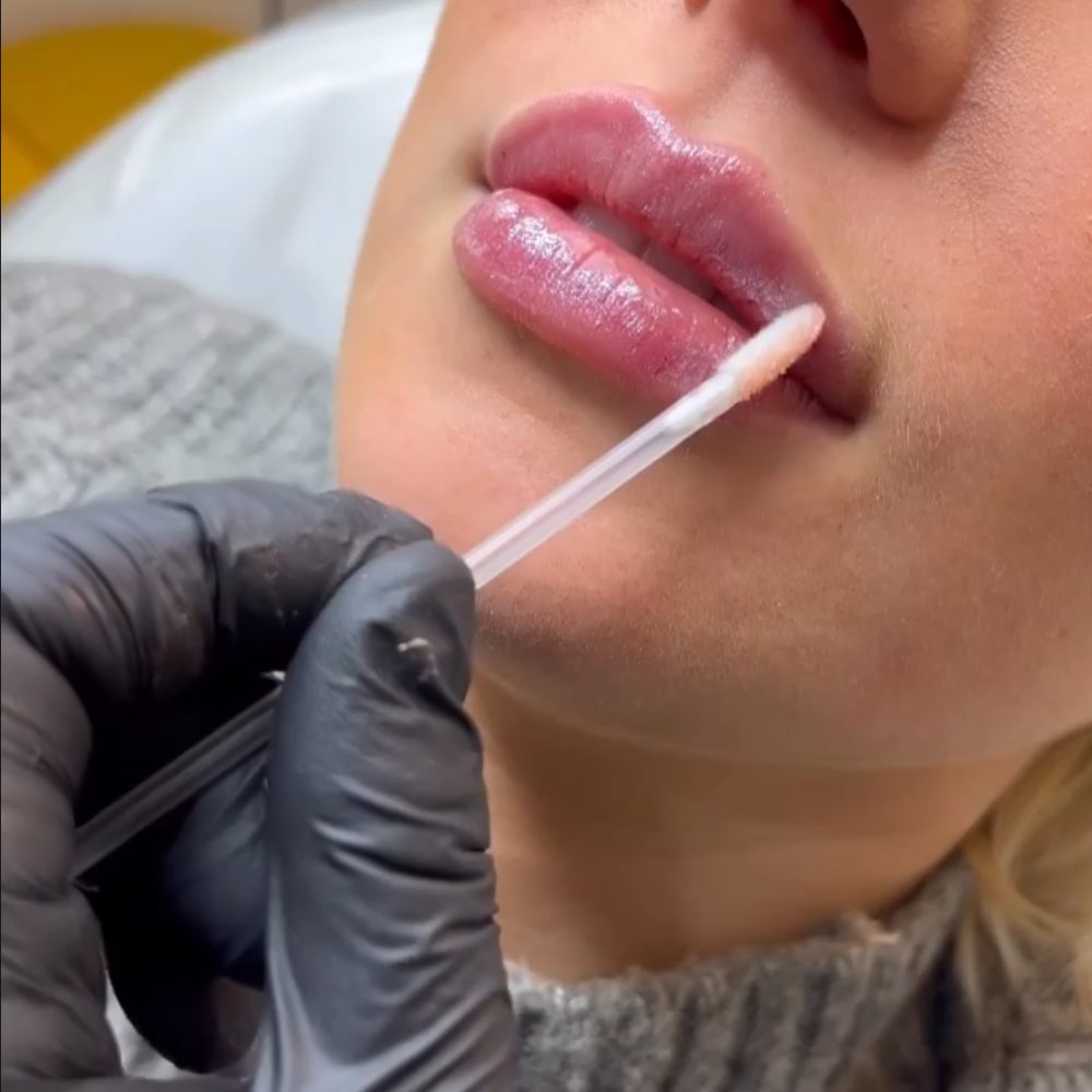 Dermal Filler